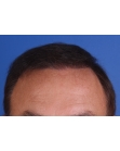 After Hair Transplant &nbsp;Front